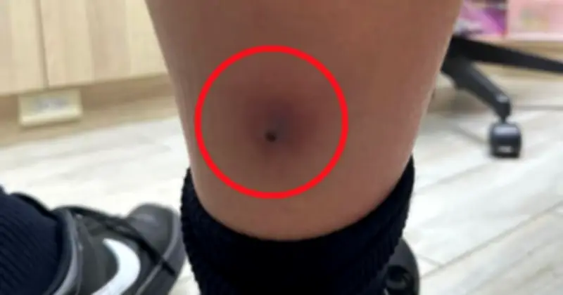 Bé trai 12 tuổi sốt tái phát, bác sĩ kiểm tra chân phát hiện nguy cơ nhiễm trùng chết người