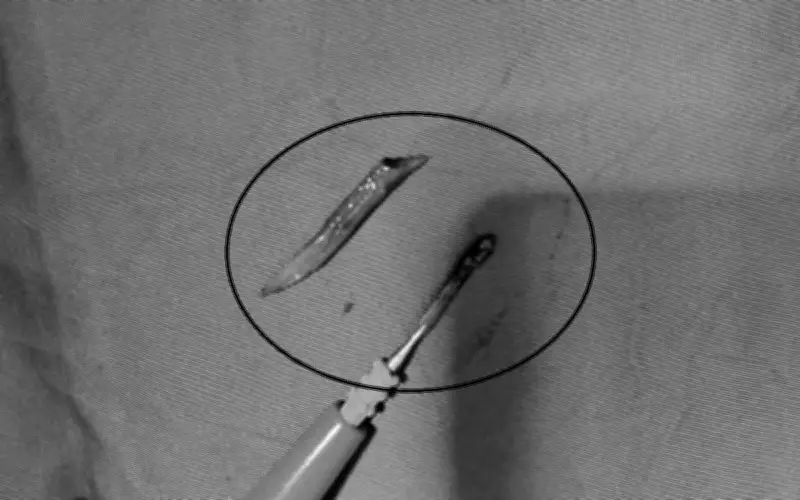 Xương cá dài 3cm đâm thủng ruột non, bác sĩ cảnh báo nguy hiểm từ mẹo dân gian
