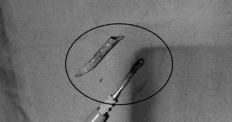 Xương cá dài 3cm đâm thủng ruột non, bác sĩ cảnh báo nguy hiểm từ mẹo dân gian