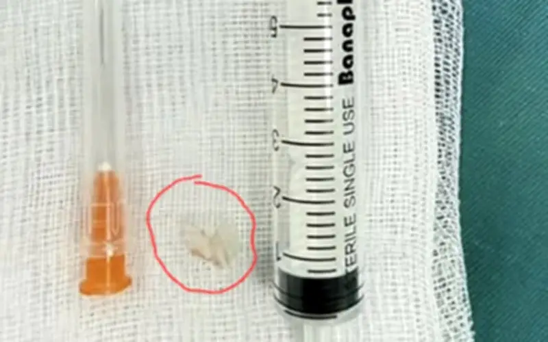 Bé 7 tuổi suýt mất mạng vì mảnh nhựa bít kín phế quản, bác sĩ cảnh báo nguy cơ dị vật đường thở