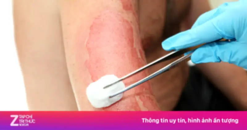 Bé gái bỏng 70% cơ thể được cứu sống kỳ diệu tại TP.HCM sau hai tháng điều trị