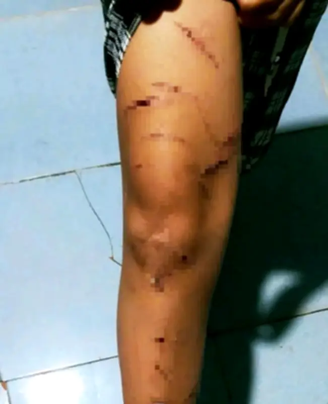 Bé gái lớp 5 bị chị họ dùng dao rạch nhiều vết trong 6 ngày tại nhà bà ngoại