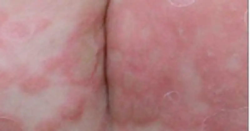 Bé trai 3 tuổi mắc giang mai bẩm sinh do bố mẹ điều trị không đúng phác đồ