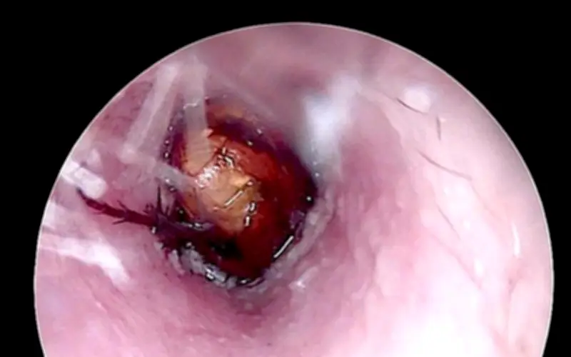 Bác sĩ Quảng Bình gắp thành công côn trùng sống trong tai bệnh nhân