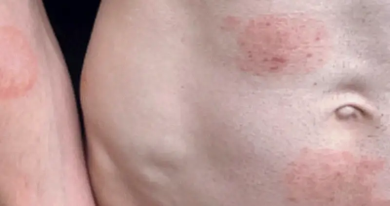 Bùng Phát Nấm Da Lây Qua Đường Tình Dục Tại Mỹ: Hàng Chục Ca Ở Minnesota