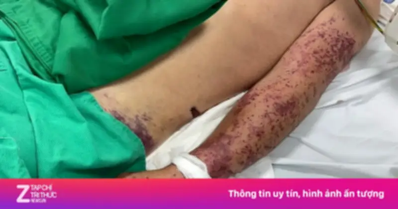 Bệnh liên cầu lợn: Mối nguy từ tiết canh và thịt tái đe dọa tính mạng