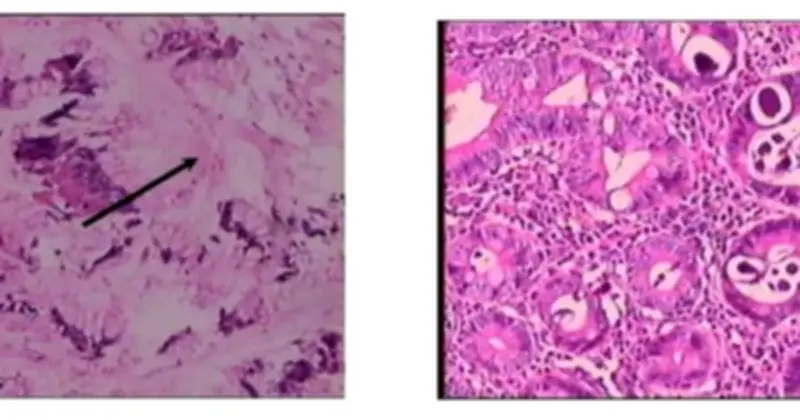 Bệnh nhân nghi ung thư dạ dày, bất ngờ phát hiện giun lươn ký sinh