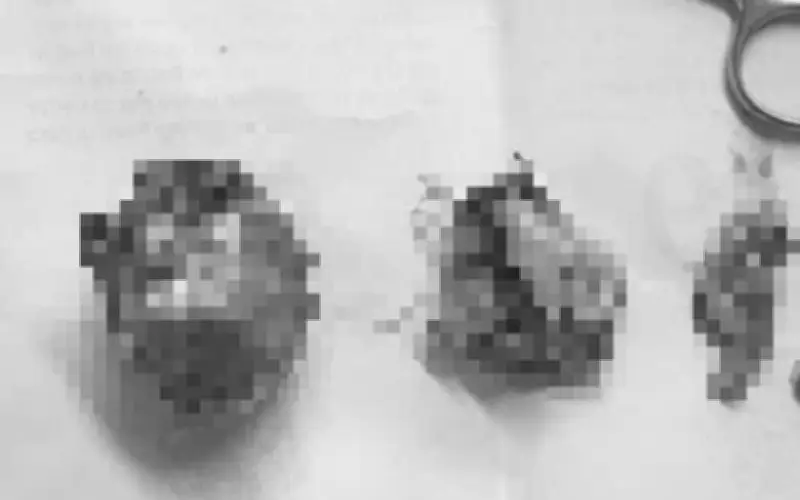 Bệnh viện Quảng Bình phẫu thuật loại bỏ 2 khối u hiếm gặp chứa tóc và xương