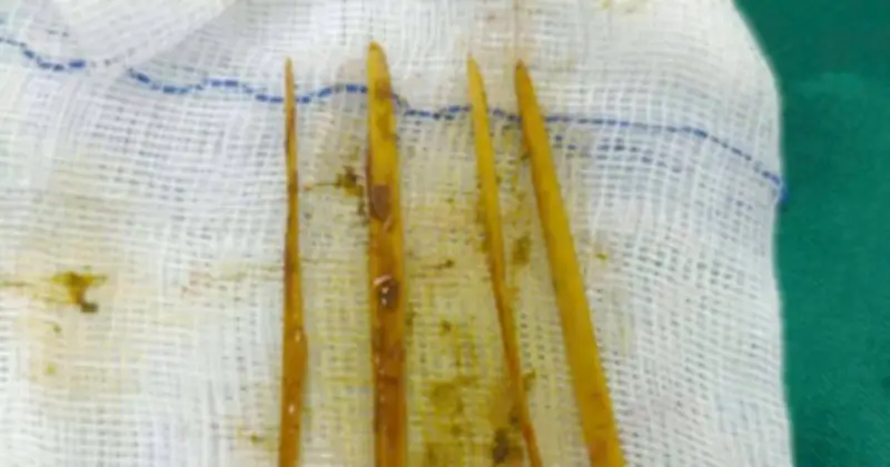 Bệnh viện Tuyên Quang phẫu thuật cấp cứu thành công bệnh nhân nuốt 3 que tăm