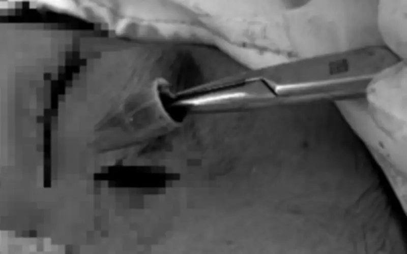 Bút Bi Nhựa 8cm Trong Hốc Mắt Bé Trai: Bác Sĩ Kiên Giang Phẫu Thuật Thành Công