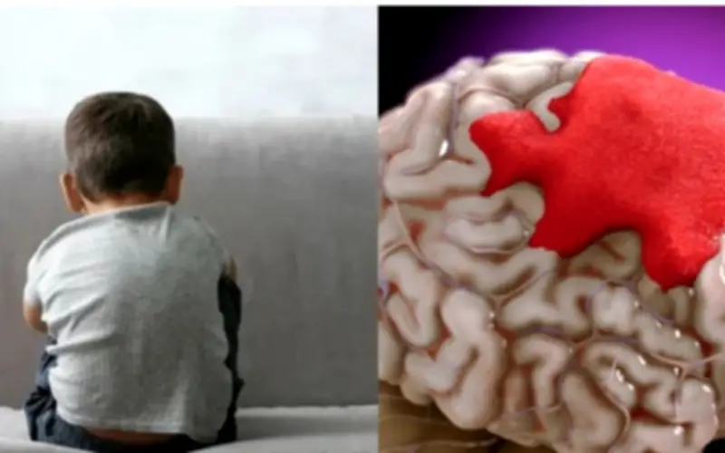 Bé trai 10 tuổi đột quỵ sau khi chơi cầu lông: Dấu hiệu dễ bị bỏ qua ở trẻ