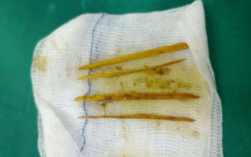 Cô gái 26 tuổi nhập viện cấp cứu vì nuốt tăm khi ăn củ cải, suýt thủng đại tràng