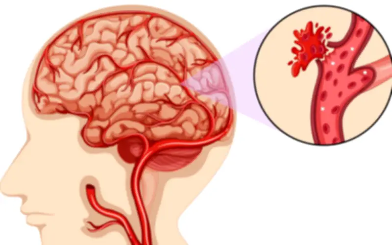 Cô gái 27 tuổi đột quỵ ở Tuyên Quang vì chủ quan bỏ qua dấu hiệu đau đầu kéo dài