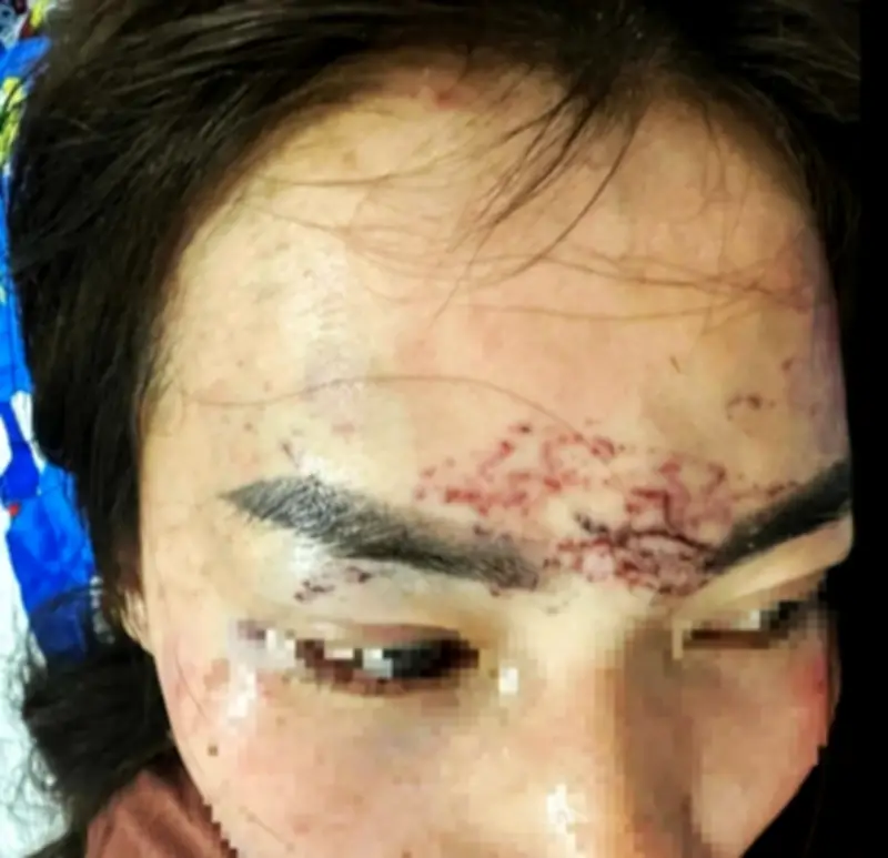 Cà Mau: Chủ cơ sở thẩm mỹ dùng kim xăm lên mặt 'tình địch' vì ghen tuông