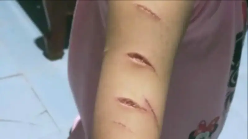 Cà Mau: Kết luận vụ nữ sinh lớp 5 bị chị họ dùng dao rọc giấy rạch nhiều vết thương