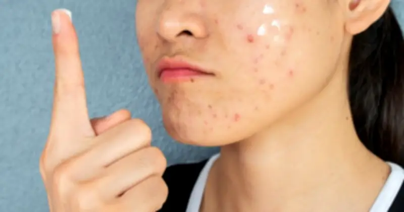 Giải mã nguyên nhân và cách khắc phục thâm mụn vùng má dai dẳng