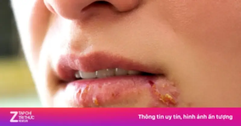 Chủ quan với nốt mụn rộp Herpes, phụ nữ Trung Quốc chịu tổn thương não vĩnh viễn