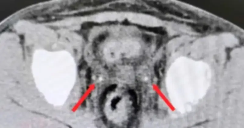 Bệnh viện Nhi đồng 2 cứu sống bé 9 tuổi suy thận cấp do sỏi niệu quản hiếm gặp