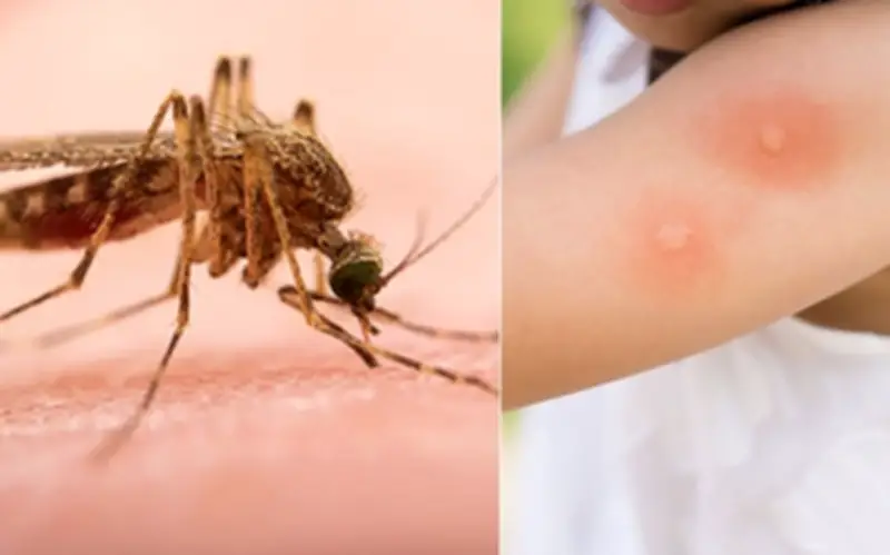 Côn trùng đốt: Nhận diện, xử trí và phòng ngừa dị ứng nguy hiểm