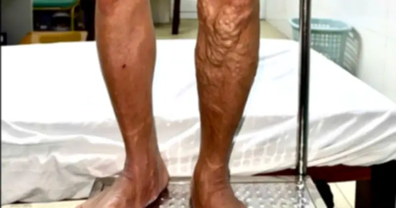 Cận Tết, bệnh nhân suy tĩnh mạch nặng với 'sợi dây thừng' nổi chi chít ở chân