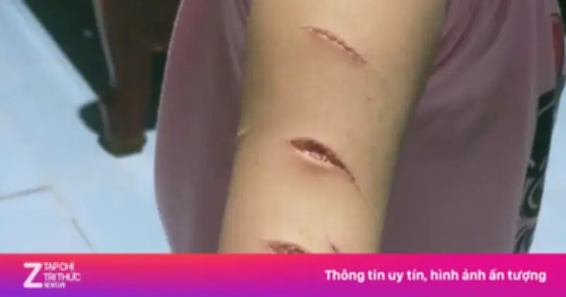 Công an Cà Mau xử lý vụ nữ sinh lớp 5 bị chị họ dùng dao rạch tay