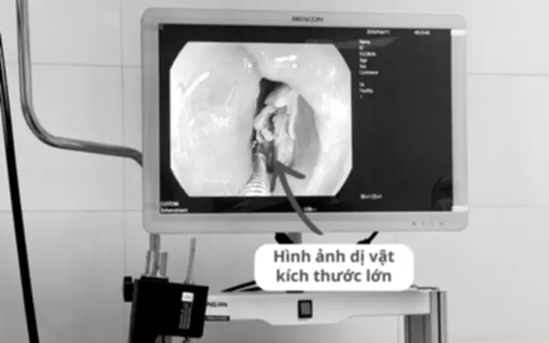 Cảnh báo nguy cơ hóc xương dịp Tết: Hai ca cấp cứu ở Hà Tĩnh và Hà Nội