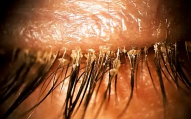 Cảnh báo nguy cơ nhiễm rận mi sau khi nối mi: Trường hợp 24 tuổi ở Vũ Hán