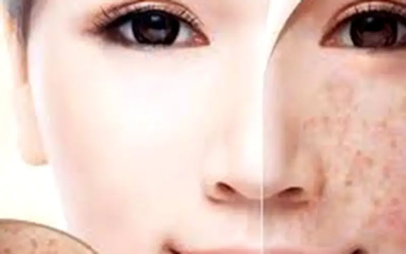 Cảnh báo: Thủ phạm gây đốm đỏ, mụn nước trên da cần nhận diện sớm