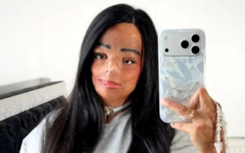 Cô Gái Anh Vượt Qua Bi Kịch Bỏng Nặng, Trở Thành Sinh Viên Tâm Lý Đầy Nghị Lực