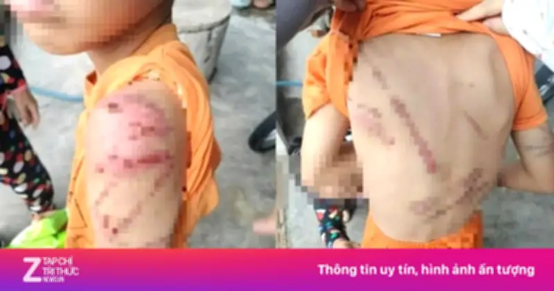 Công an Đắk Lắk vào cuộc điều tra vụ bé trai 10 tuổi bị bạo hành chi chít vết thương