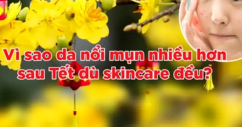 Da nổi mụn sau Tết dù skincare kỹ: Nguyên nhân từ nội tiết và cách xử lý hiệu quả