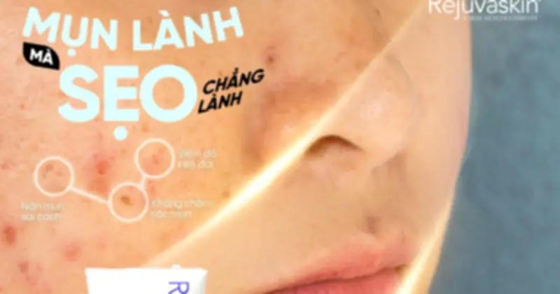 Da Sau Mụn Chịu Tổn Thương Gì? Cơ Chế Hình Thành Thâm Sẹo Và Giải Pháp Phục Hồi