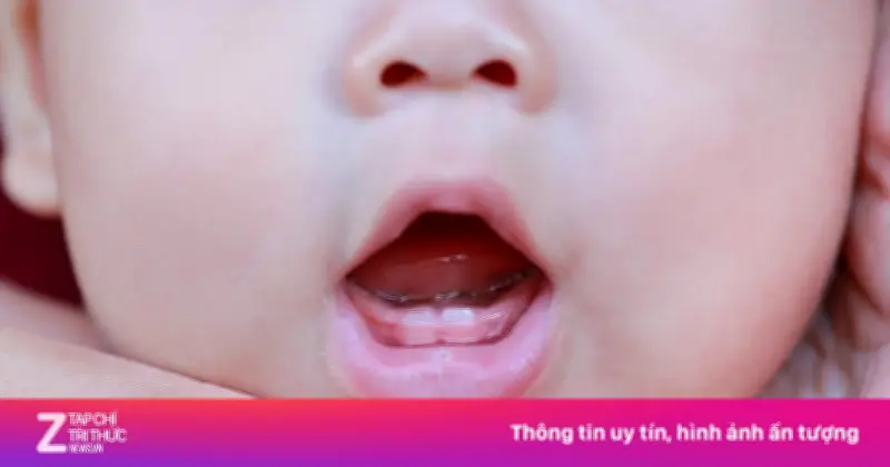 Dấu hiệu nhận biết trẻ bắt đầu mọc răng sữa và cách chăm sóc hiệu quả