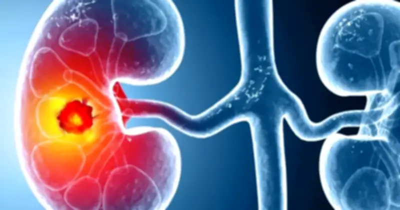 Ung thư thận gia tăng toàn cầu: 3 dấu hiệu cảnh báo dù ở giai đoạn sớm hay muộn