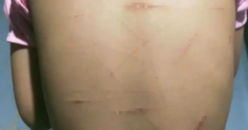 Học sinh lớp 5 bị chị họ dùng dao rạch nhiều vết thương trong 6 ngày