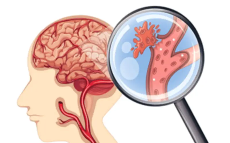 Hiểu Đúng Tai Biến Mạch Máu Não Để Phòng Ngừa Từ Sớm, Tránh Hậu Quả Nặng Nề