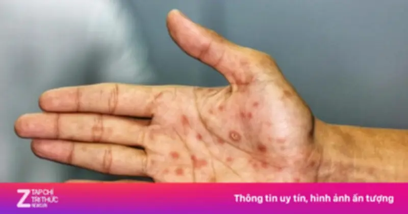 Một phút buông thả, nhiều tháng lo âu: Cảnh báo bệnh tình dục tăng cao dịp cuối năm