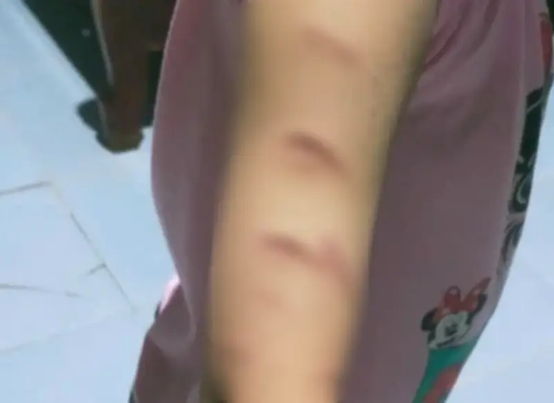 Nữ sinh lớp 5 ở Cà Mau bị chị họ rạch tay nhiều lần do mâu thuẫn, không khởi tố vụ án