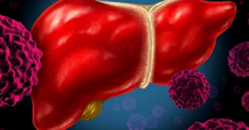 Nghiên cứu MIT cảnh báo: Chế độ ăn giàu chất béo kéo dài có thể là 'thủ phạm' âm thầm gây ung thư gan