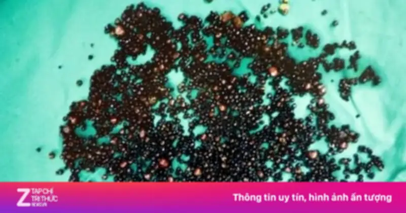 Người đàn ông Đài Loan có túi mật chứa gần 5.000 viên sỏi do thói quen ăn uống xấu