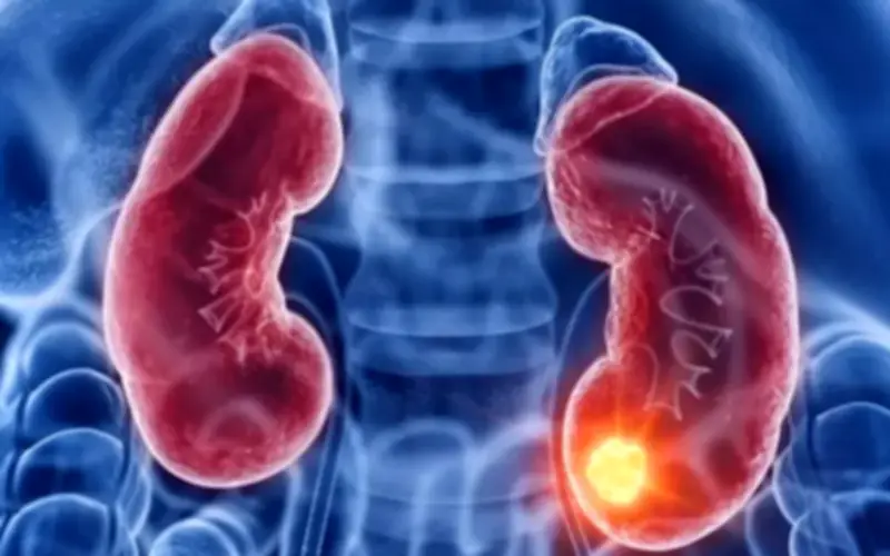 Người đàn ông suy thận giai đoạn 3 ăn hạn vì tự ý làm điều này khiến bệnh trầm trọng hơn