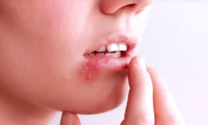 Người phụ nữ 30 tuổi chết não vì chủ quan với mụn rộp khóe miệng