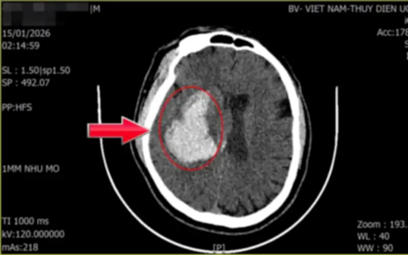 Người đàn ông 44 tuổi khỏe mạnh đột quỵ: Dấu hiệu nhiều người Việt mắc phải