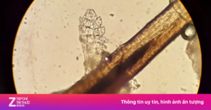 Nối mi đón Tết, cô gái trẻ bị 64 con rận ký sinh trong mí mắt gây viêm bờ mi