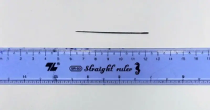 Bệnh nhân Vĩnh Long được phẫu thuật lấy kim may đồ dài 6 cm từ gan