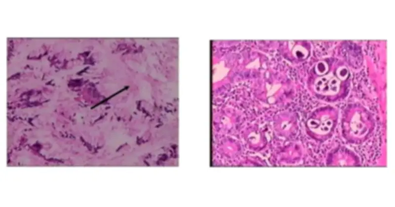 Bệnh nhân nghi ung thư dạ dày, bất ngờ phát hiện giun lươn ký sinh trong ruột