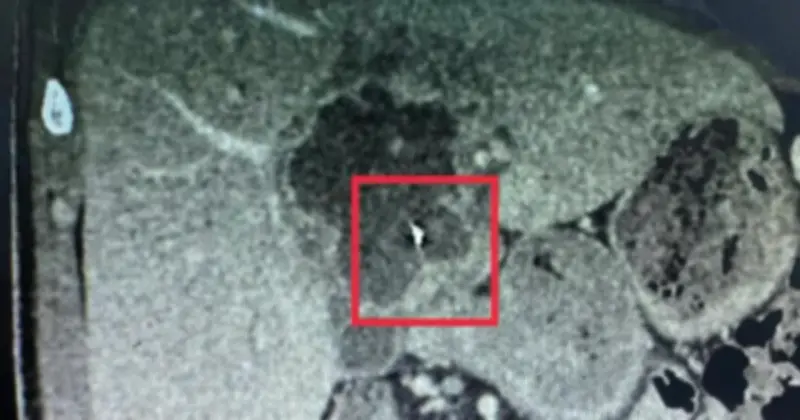 Bệnh nhân Vĩnh Long nuốt kim may 6cm, gây áp xe gan phải phẫu thuật cấp cứu