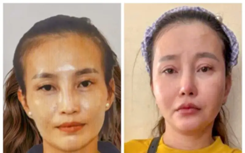Phẫu Thuật Thẩm Mỹ Để Trốn Truy Nã, Bị Can Vẫn Bị Công An Cà Mau Bắt Giữ