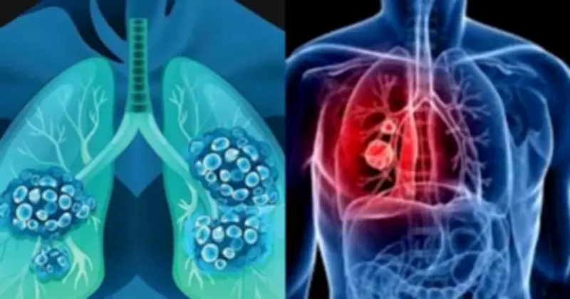 Nghiên cứu: Gần 40% ca ung thư mới có thể phòng ngừa nhờ thay đổi lối sống