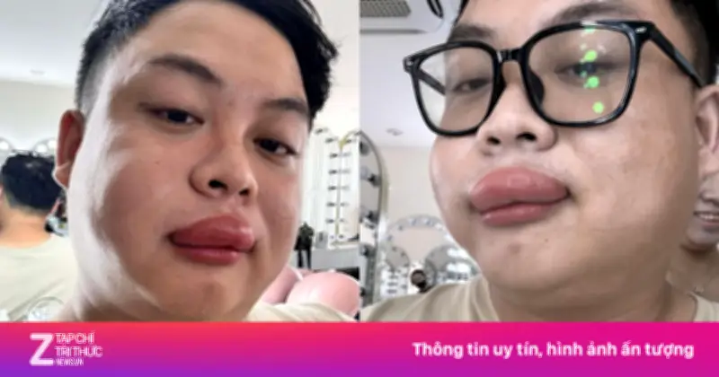 Thợ Trang Điểm Và Cô Dâu Vĩnh Long Bị Ong Chích Sưng Vù Mặt Trong Ngày Cưới